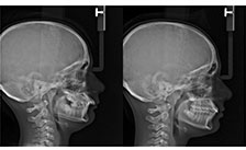 Lateral Ceph