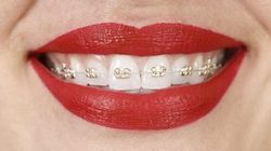 champagne braces